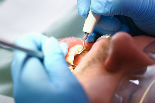Best Emergency Wisdom Tooth Extraction in Terrytown, LA